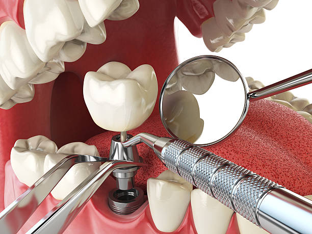 Best Root Canal Emergency Dentist  in Harbor Bluffs, FL